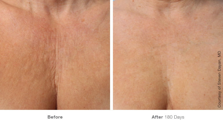 Skin improvement before and after Ultherapy treatments