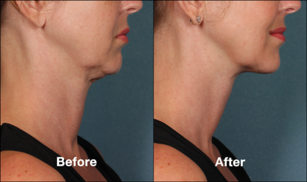 Before and after Kybella treatment in the chin