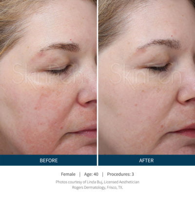 Real patient improvement in skin texture and tone after SkinPen microneedling treatments