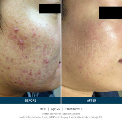 Before and after SkinPen microneedling treatment for acne
