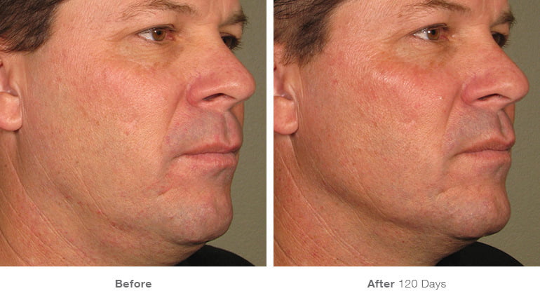 Real male patient shown before and after Ultherapy