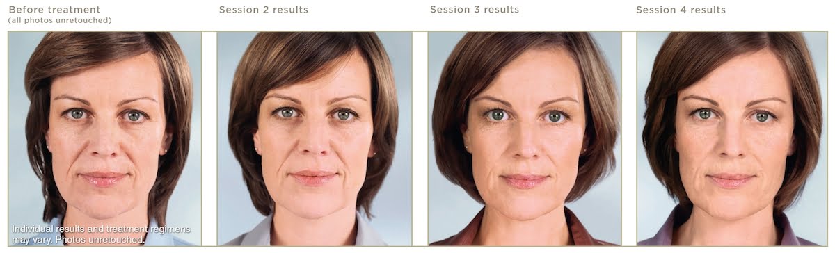 Before and after Sculptra Aesthetic injectable tretments