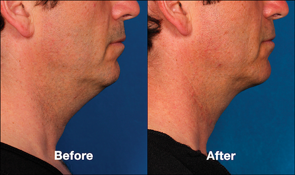 Real male patient shown before and after treatment with Kybella