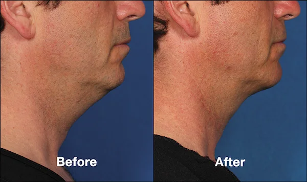 Real male patient shown before and after treatment with Kybella