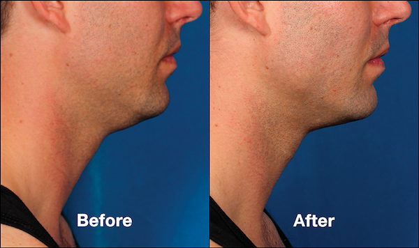 Male patient shown before and after Kybella chin and neck treatments