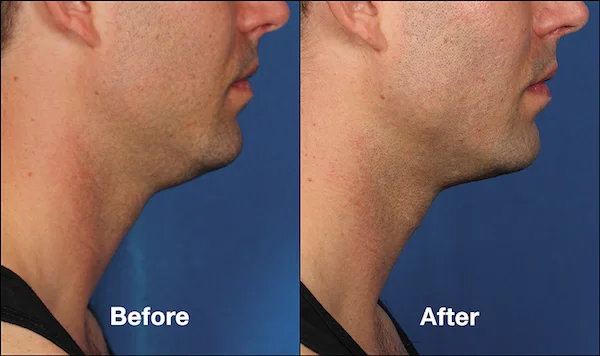 Male patient shown before and after Kybella chin and neck treatments