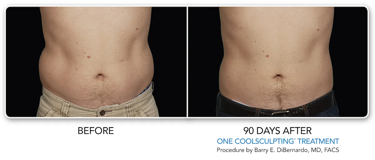 Real male patient shown before and after Fort Worth CoolSculpting treatment