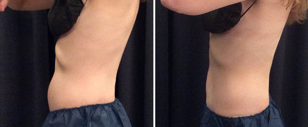 coolsculpting before and after results on abdomen