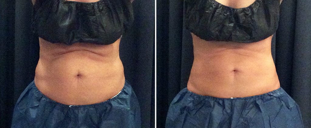 coolsculpting before and after results on abdomen