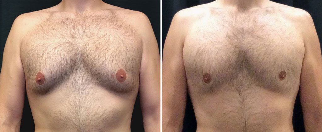 coolsculpting before and after results on male chest