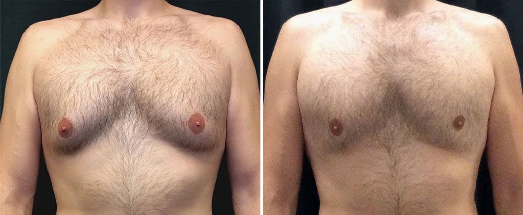 Before and after photo of Kalos male CoolSculpting patient.