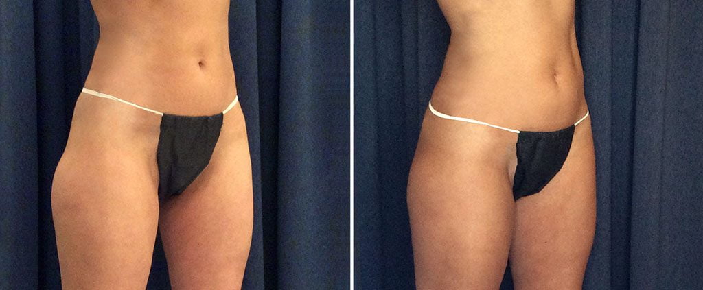 coolsculpting before and after results one lower abdomen and thighs