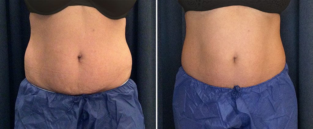 coolsculpting before and after results on abdomen