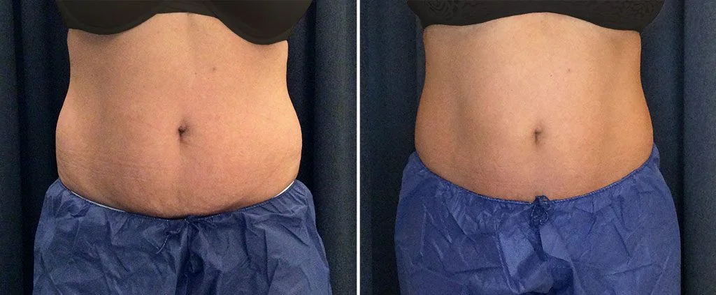 Fort Worth CoolSculpting, Non-Surgical Fat Reduction