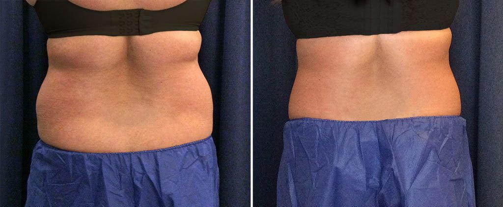 Before and after photo of CoolSculpting patient.