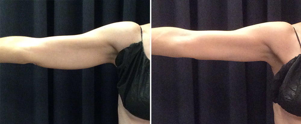 coolsculpting before and after results on upper arms
