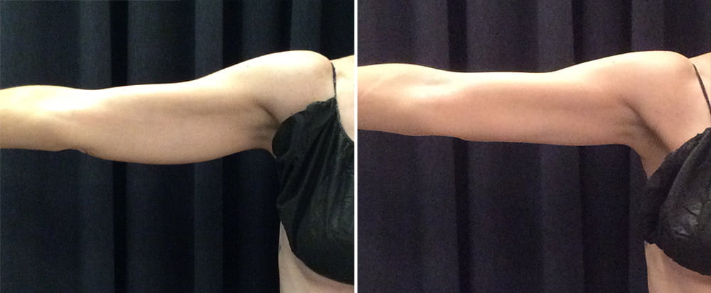 Before and after photo of Kalos CoolSculpting patient.