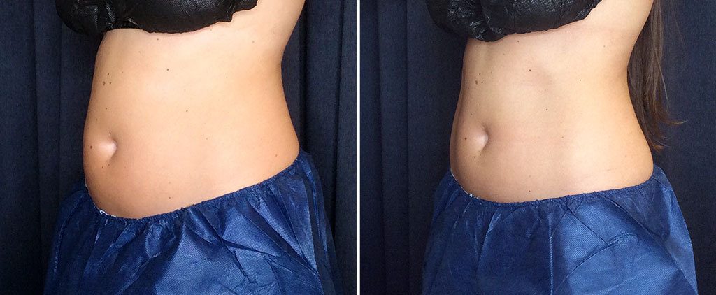coolsculpting before and after results on abdomen