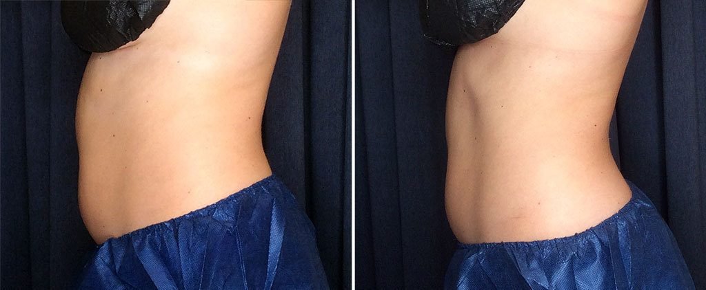 coolsculpting before and after results on abdomen