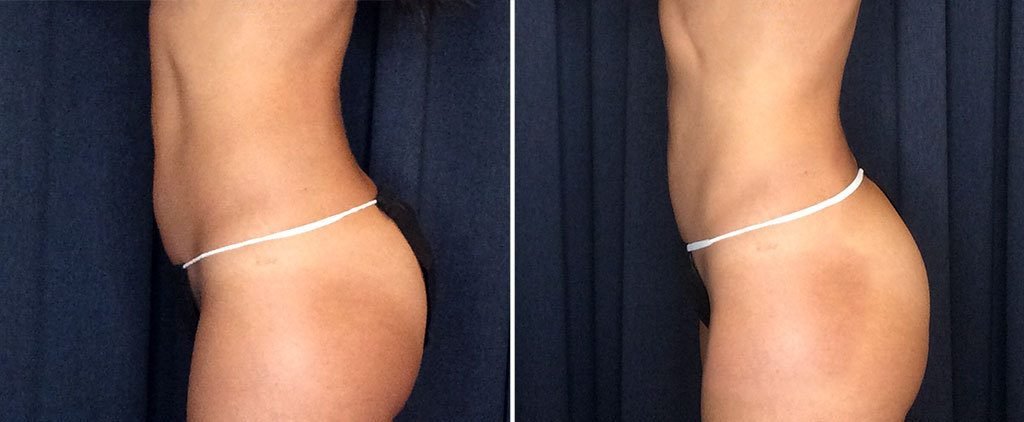 coolsculpting before and after results on abdomen and buttocks