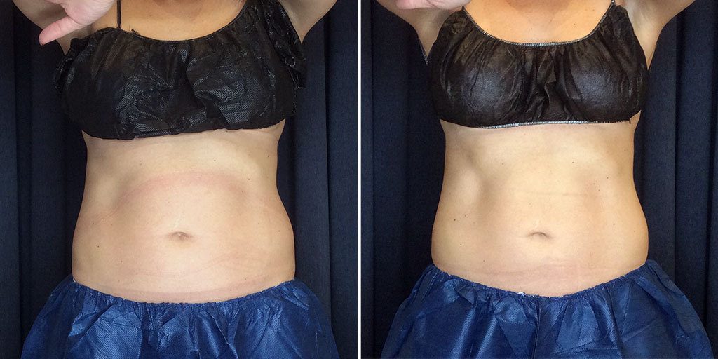 coolsculpting before and after results on abdomen