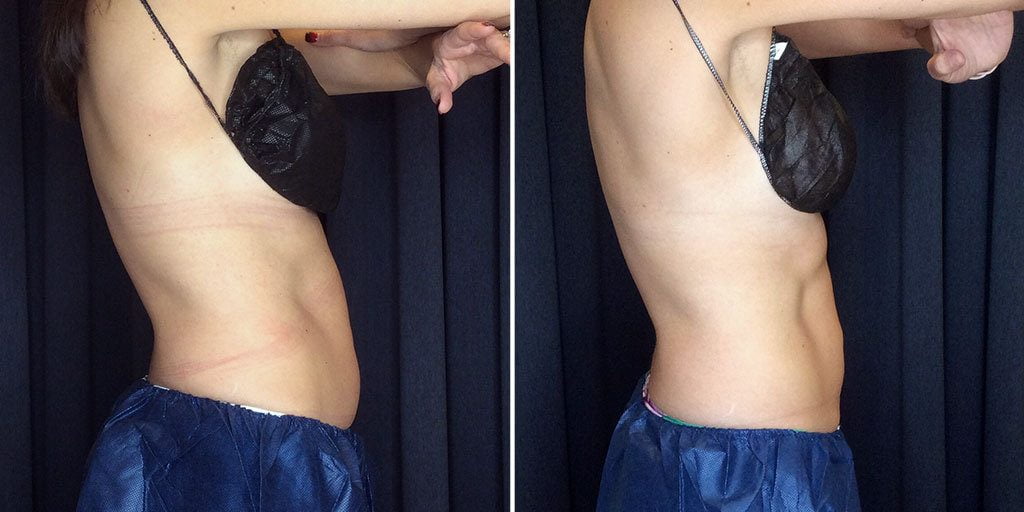 coolsculpting before and after results on abdomen