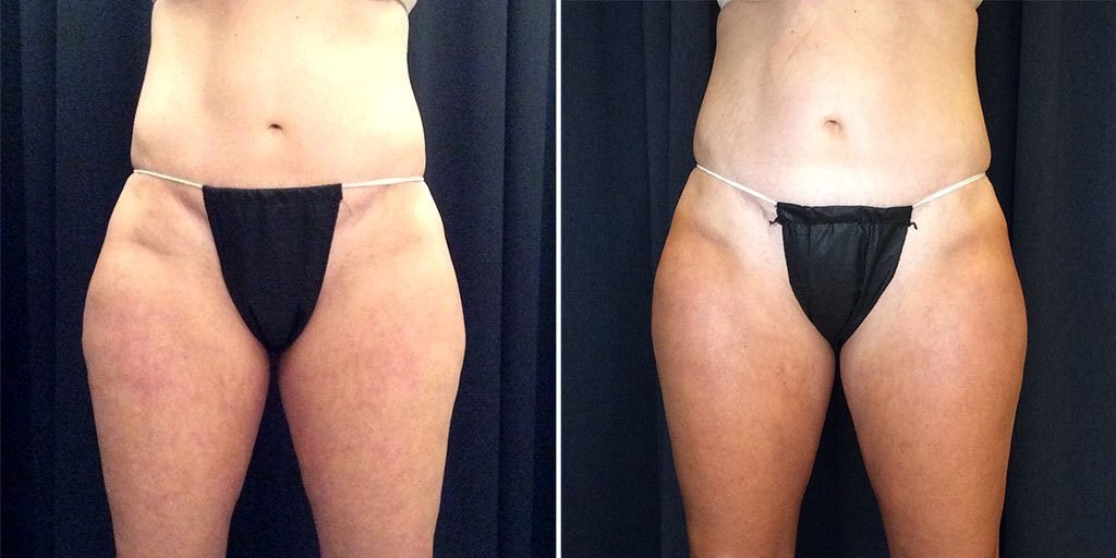 coolsculpting before and after results on thighs