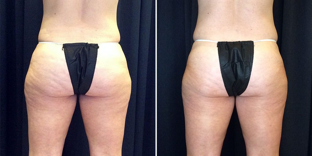 coolsculpting before and after results on buttocks