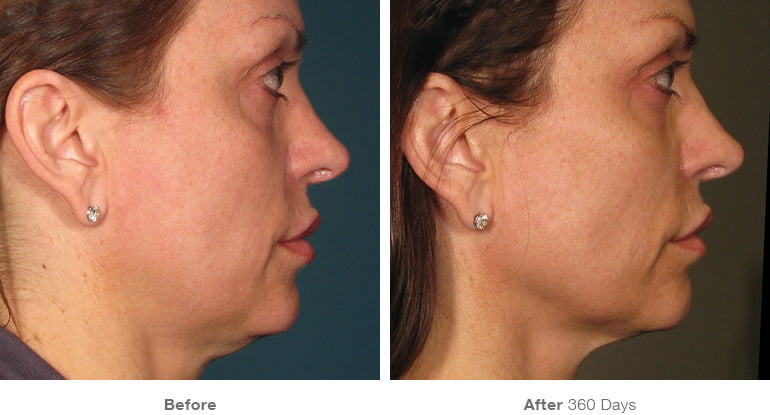 Before and after Ultherapy non-surgical skin tightening