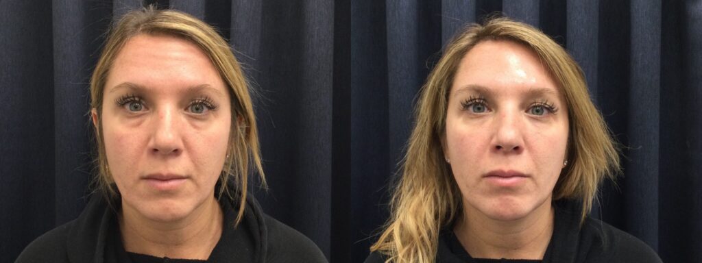 Before and After Under eye Filler