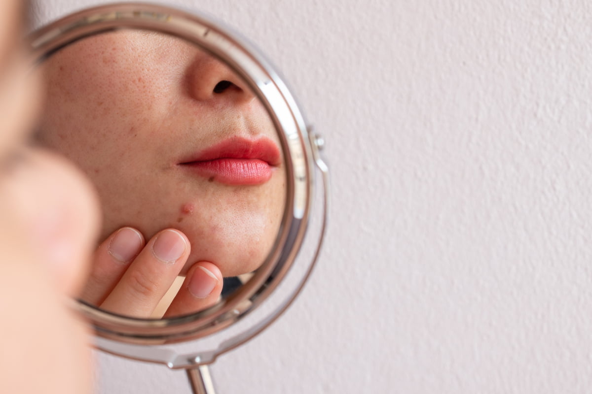 Woman with chin acne looks at breakout in mirror