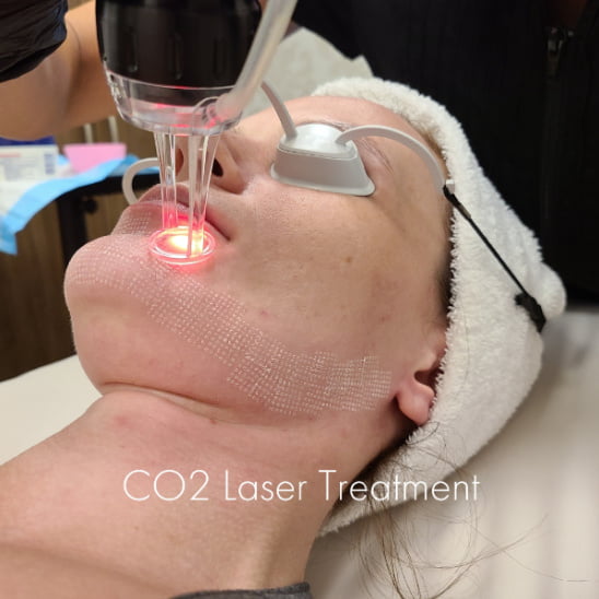 CO2 laser skin treatment at Kalos Medical Spa in Fort Worth