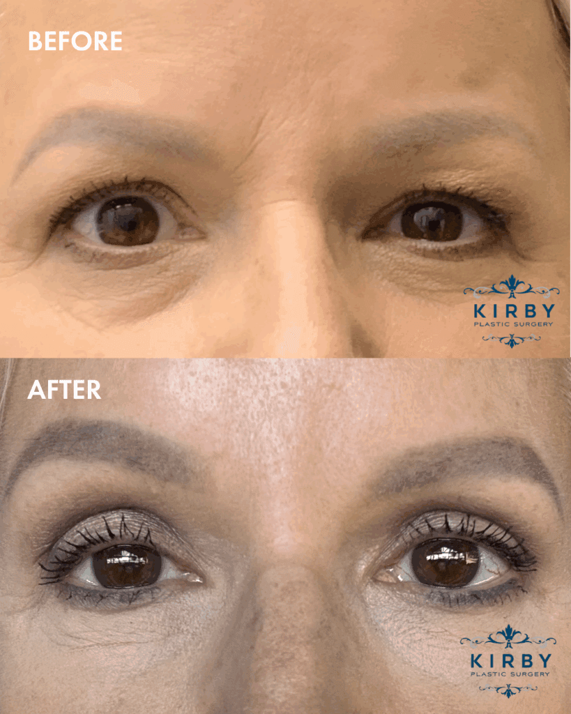 Before and after eyelid surgery to correct asymmetrical eyelids by Fort Worth plastic surgeon Dr. Emily J. Kirby