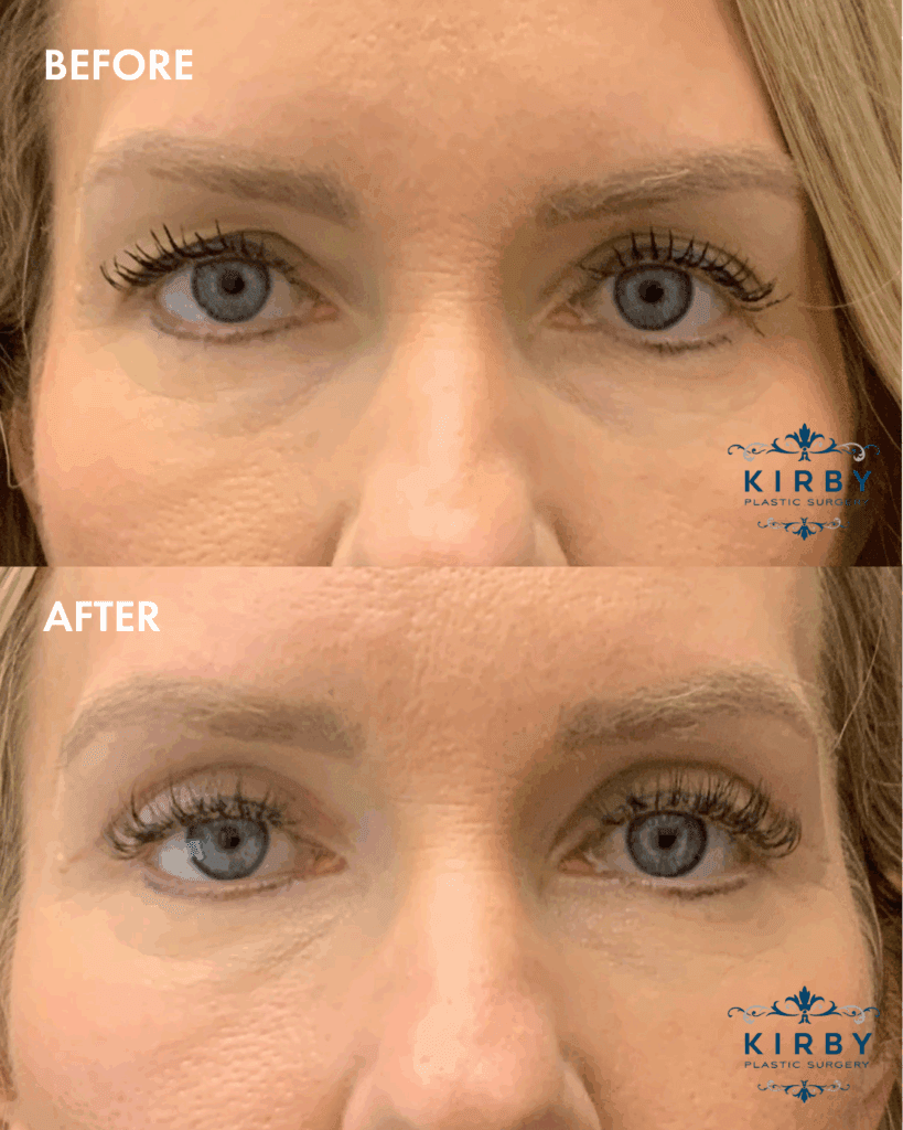 Before and after eyelid surgery to remove excess sagging eyelid skin by Fort Worth plastic surgeon Dr. Emily J. Kirby