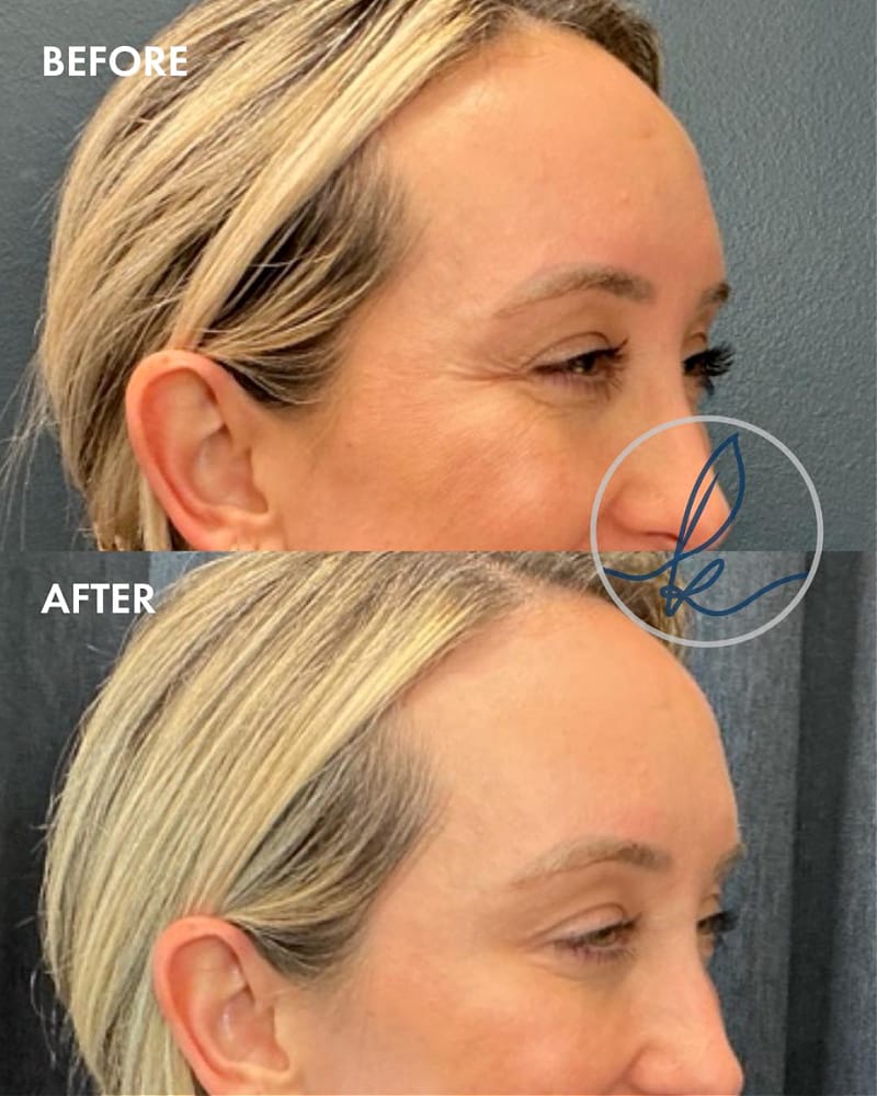 Before and after crows feet treatment as part of non-surgical facial rejuvenation plan at Kalos Medical Spa in Fort Worth