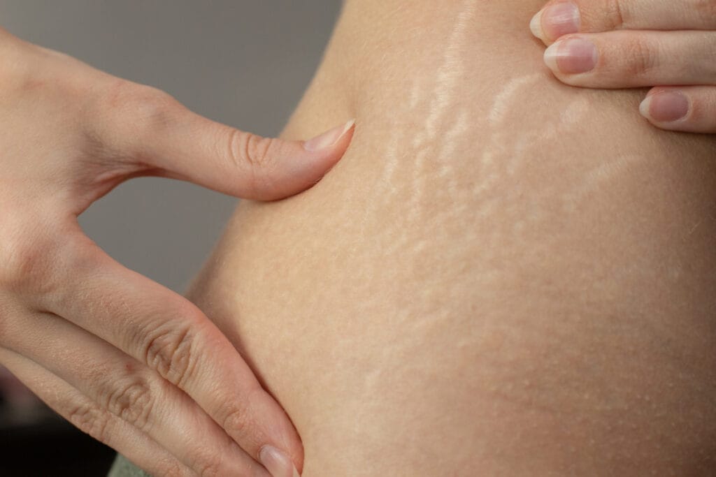 Close up of striae alba mature stage stretch marks