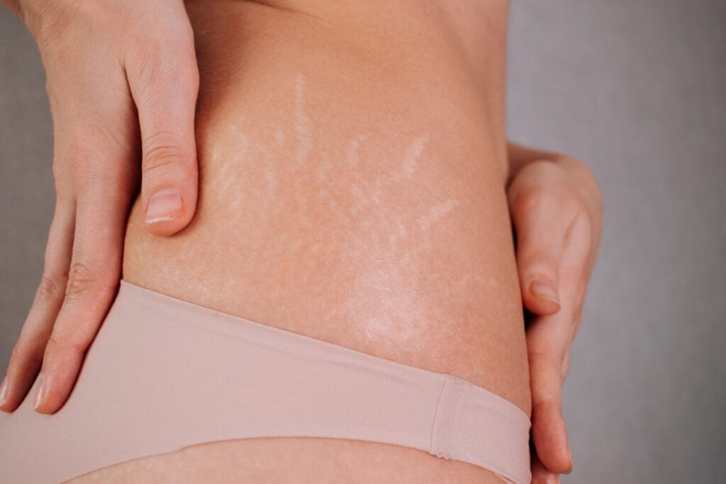 Close up of stretch marks on woman's lower abdomen and hips